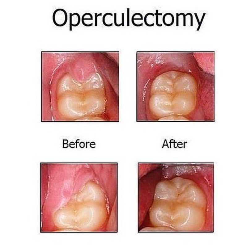 Operculectomy before and after