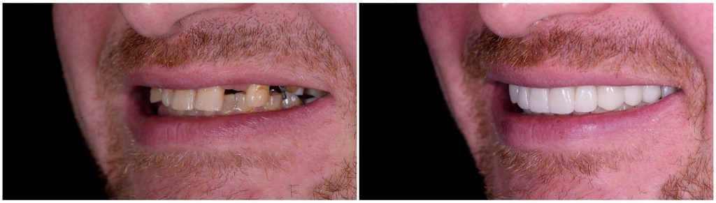 Mouth Reconstruction