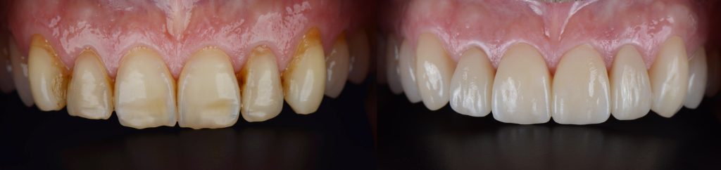 Teeth Cleaning & Whitening