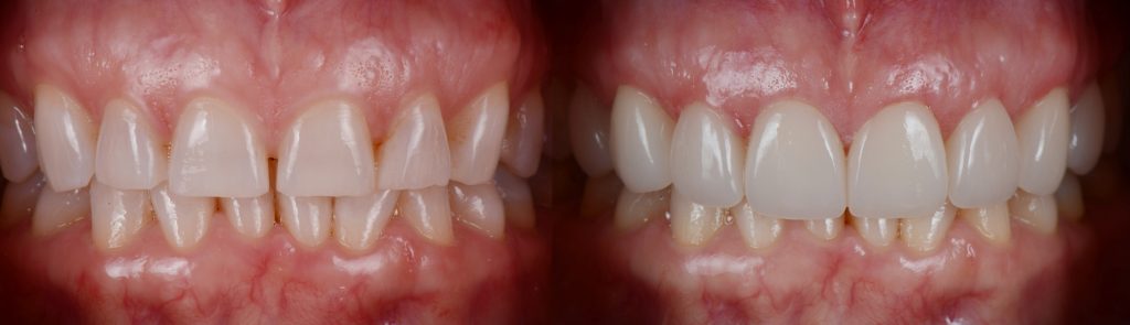 Cosmetic Dentistry Porcelain Veneers
