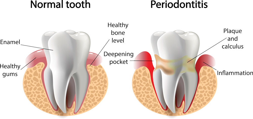 Periodontitis