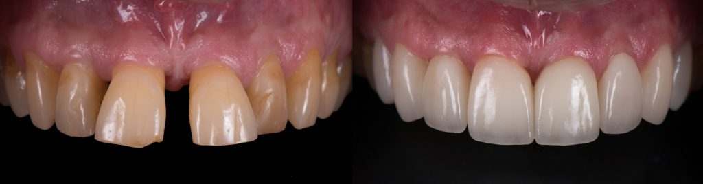 Cosmetic Dentistry - Crowns & Veneers